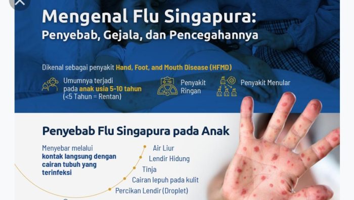 Kenali Tips Mencegah Tertular Virus Flu Singapura